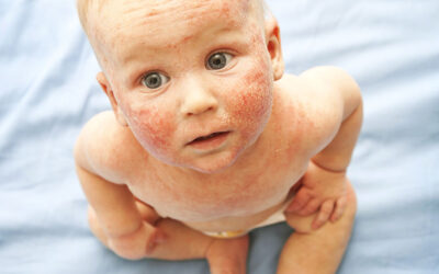 Co je atopický ekzém?